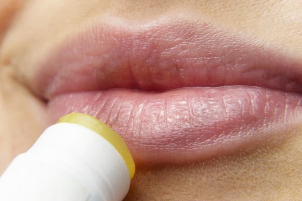 ¿Qué es el herpes labial y cómo mejora con própolis?
