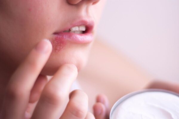 Propóleo, más eficaz que el aciclovir para el herpes labial según los estudios